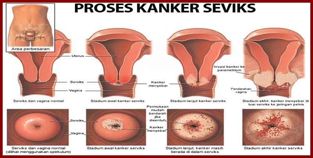 INSPESKSI VISUAL ASAM ASETAT (IVA), APA MANFAATNYA?